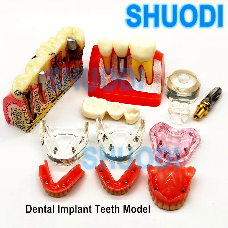 1 piece Dental Implant Demonstration Model Teeth Study Teach Model Communication Dental Overdenture Interior Mandibular Model
