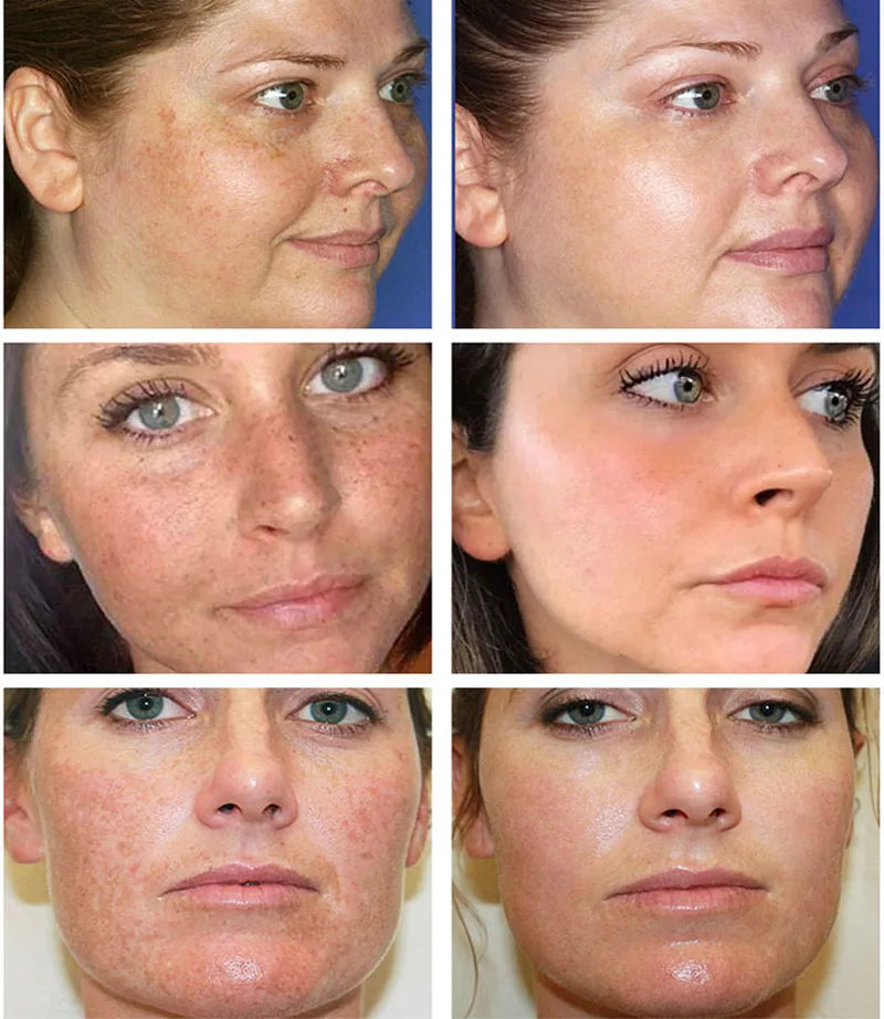 Effective Whitening Freckle Cream Remove Melasma Acne Spot Pigment Melanin Dark Spots Pigmentation Moisturizing Gel Skin Care