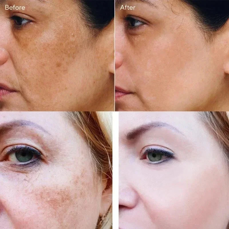 Vitamin C Whitening Freckles Serum Cream Remove Dark Spots Melasma Niacinamide Lighten Melanin Acne Scars Anti-aging Skin Care