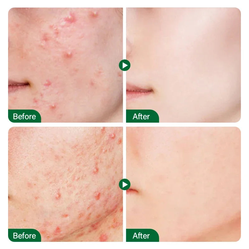 Salicylic Acid Acne Treatment Cream Repair Pimple Spots Serum Cleaning Pore Anti-acne Oil Control Moisturizer Smooth Skin Care