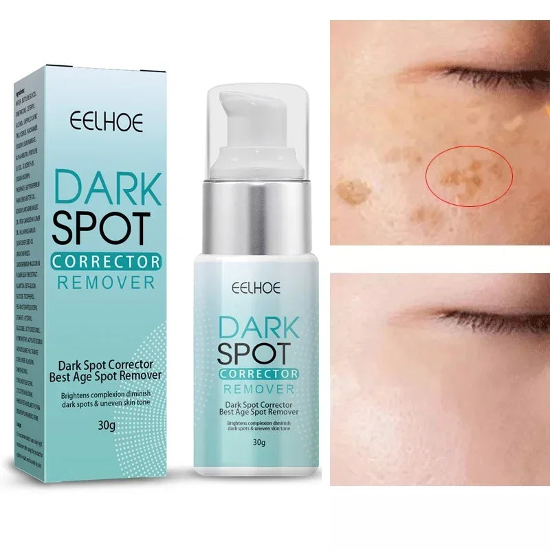 Instant Whitening Freckle Cream Nicotinamide Remove Face Melasma Dark Spot Melanin Moisturizer Anti-aging Brighten Skin Care
