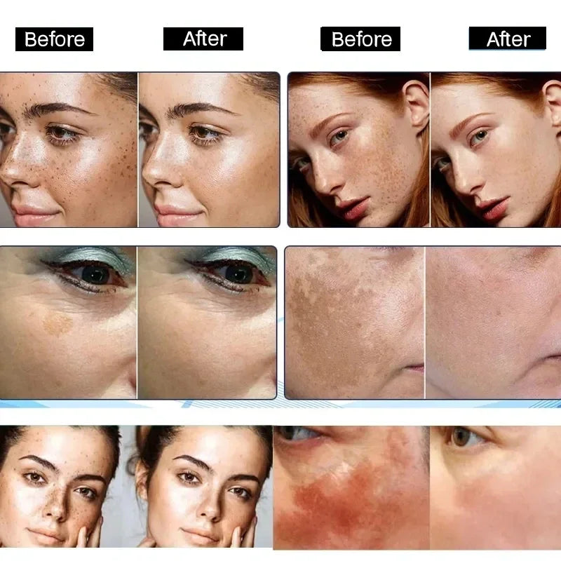 Niacinamide Dark Spot Remove Serum Anti-aging Bright Freckle Whiten Skin Cream Fade Pigmentation Melasma Moisture Face Skin Care