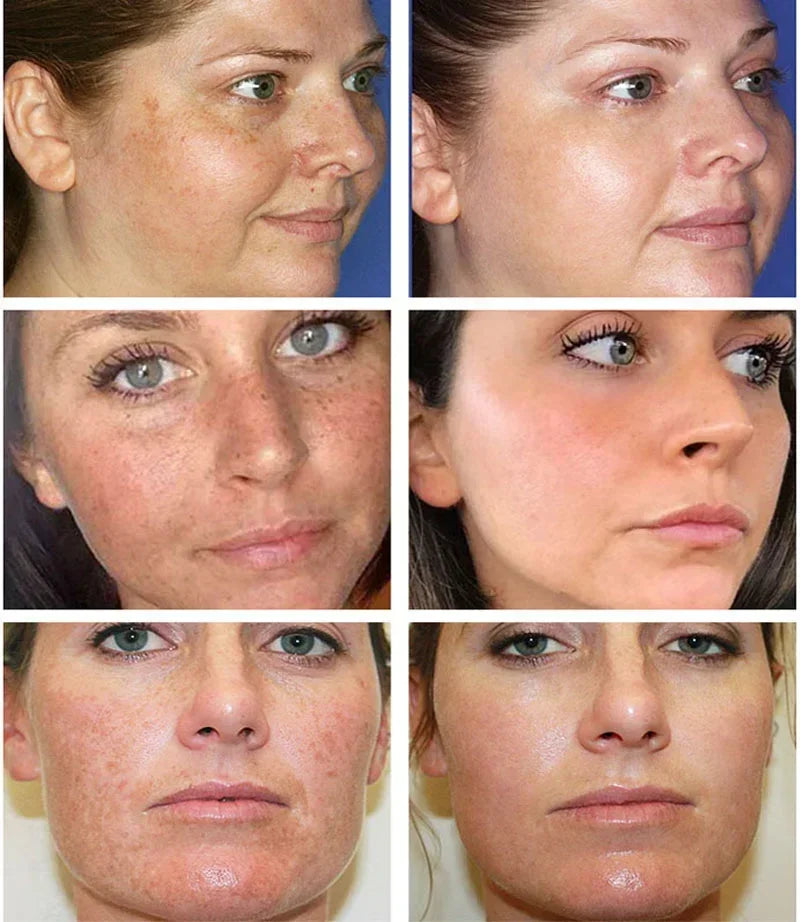 Instant Whitening Freckle Cream Nicotinamide Remove Face Melasma Dark Spot Melanin Moisturizer Anti-aging Brighten Skin Care