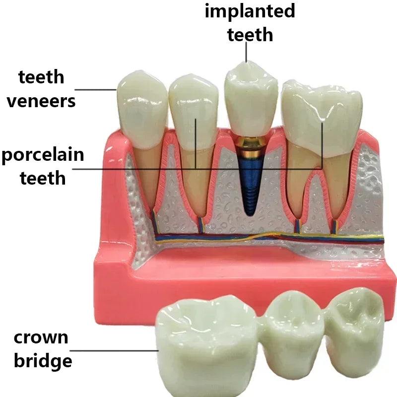 New Dental Implant Teach Crown Bridge Removable Model Porcelain Teeth Model Dental Demonstration Model for Dentist Teaching