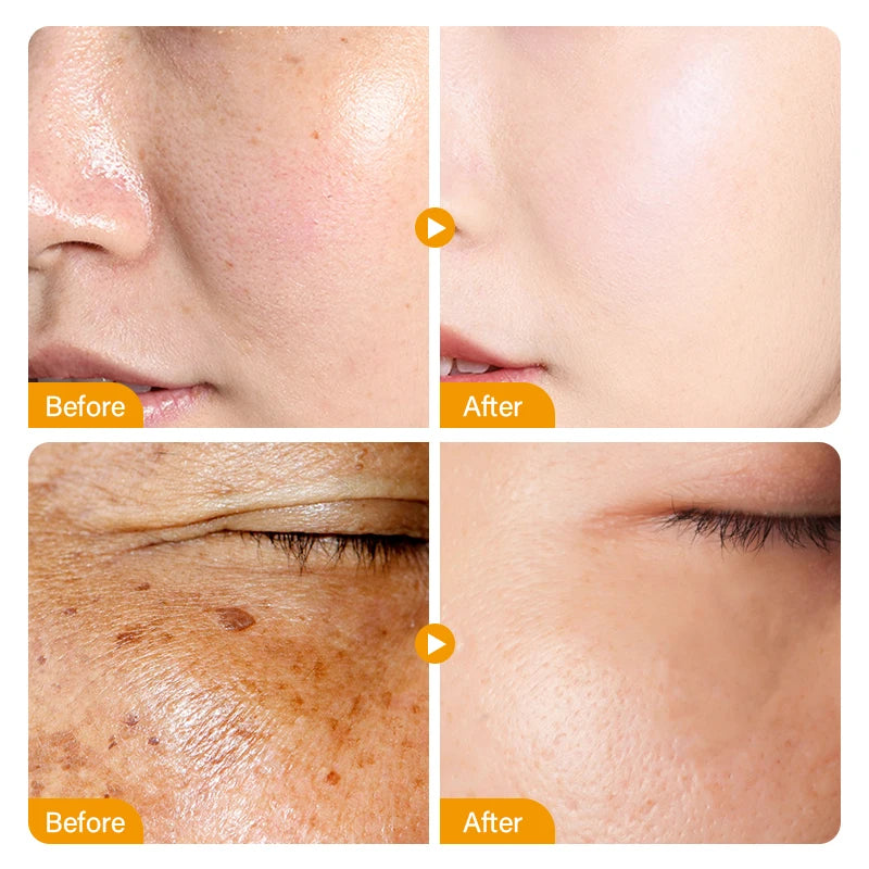 Vitamin C Whitening Freckles Cream Serum Remove Melasma Nicotinamide Fade Dark Spot Melanin Brighten Facial Skin Care Products