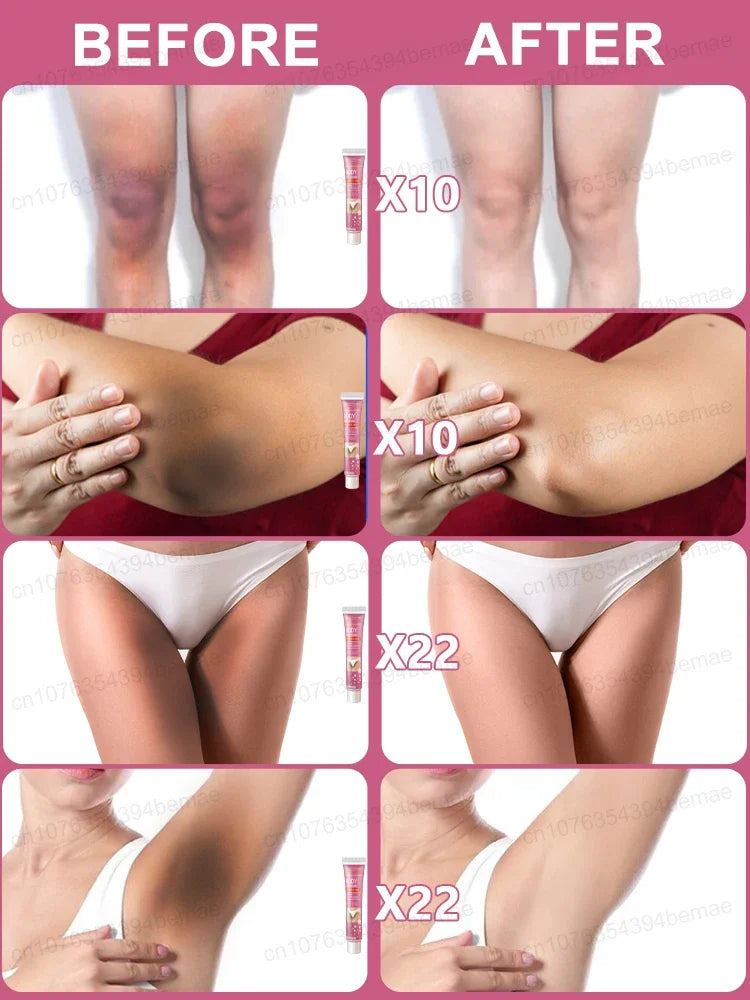 Body Whitening Cream Skin Pink Treatment Keratosis Pilaris lotion Melanin Removal Moisture Private Parts Care Safe For Women Men