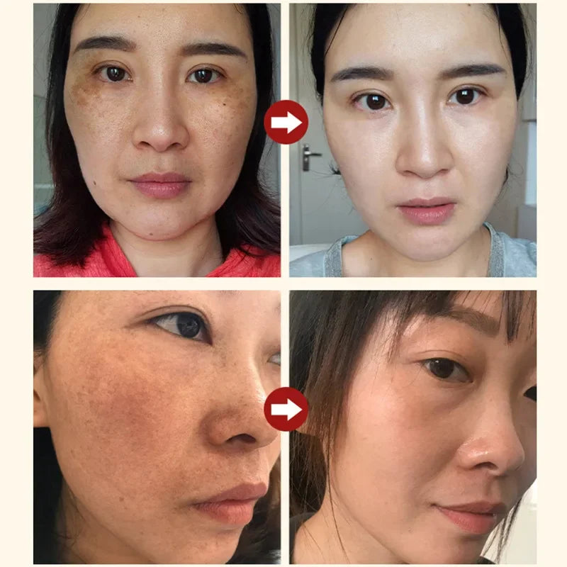 Niacinamida Whitening Face Serum Freckles Dark Spot Remover Salicylic Acid Pore Shrink Moisturizing Korean Skin Care Product30ml