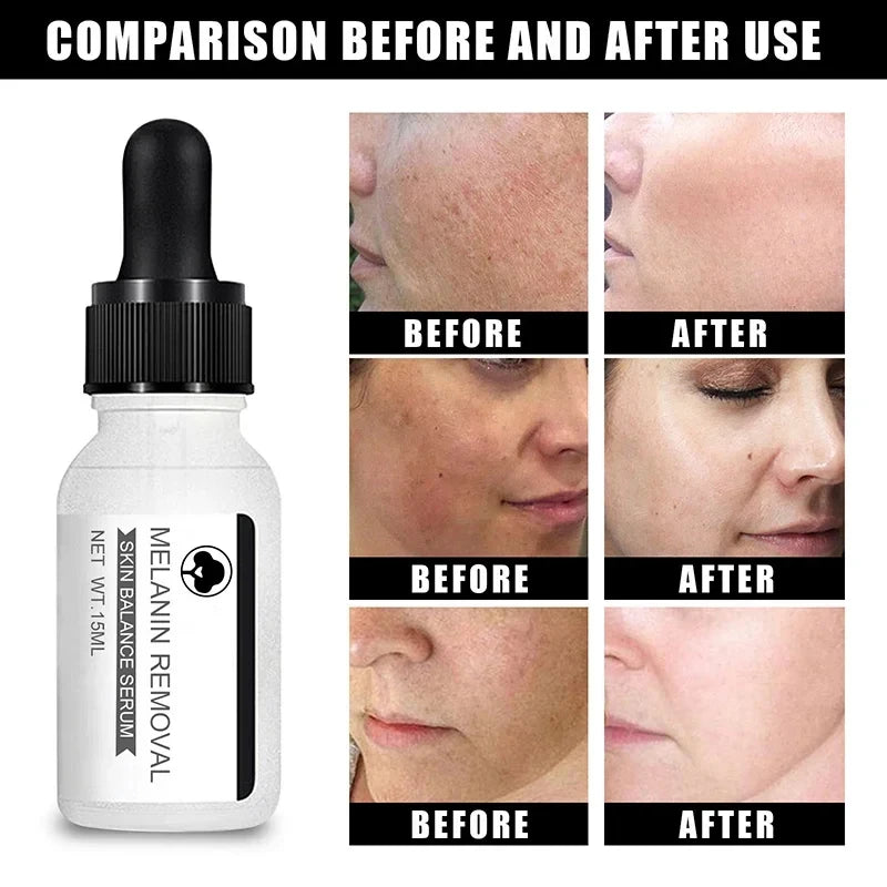 Niacinamide Whitening Serum Remove Dark Spots Freckle Essence Anti-Aging Fade Melanin Correcting Black Dot Face Skin Care Cream
