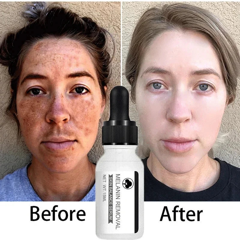 Niacinamide Whitening Serum Remove Dark Spots Freckle Essence Anti-Aging Fade Melanin Correcting Black Dot Face Skin Care Cream
